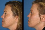 laser-facial-1