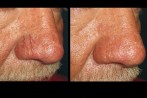 laser-veins-1