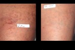 laser-veins-2