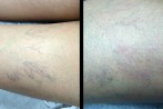laser-veins-3