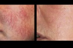 laser-veins-4