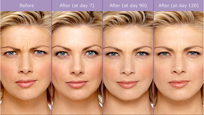 Before & After Gallery- BOTOX® Cosmetic Website