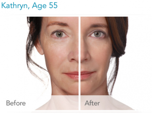 skin wrinkle treatment