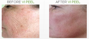 Before After - Vitality Institute - Medical Products