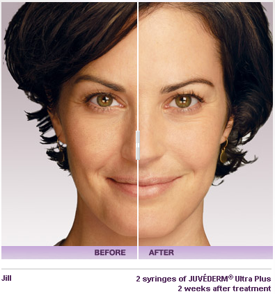 Before and After- www.Juvederm.com
