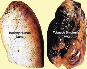 smoker's lung with cancer